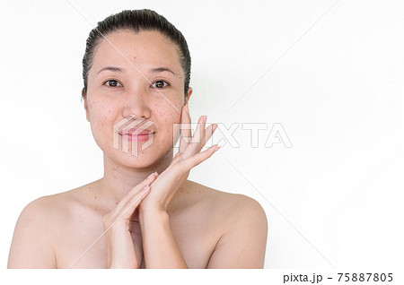 laser treatment laser treatment 75887805
