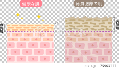 角質肥厚　健康な肌　断面図 75903111