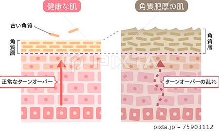 角質肥厚　健康な肌　断面図　 75903112