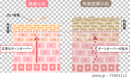 角質肥厚　健康な肌　断面図　 75903112