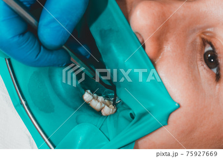 treatment of a chewing tooth, the dentist put a rubber dam, uses sterile tools, uses modern technology. treatment of a chewing tooth, the dentist put a rubber dam, uses sterile tools, uses modern technology. 75927669