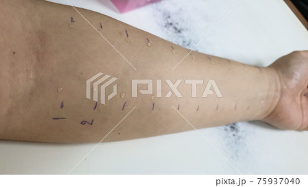 Arm test of allergy droplet examination sensitive symptom red rash all over 75937040