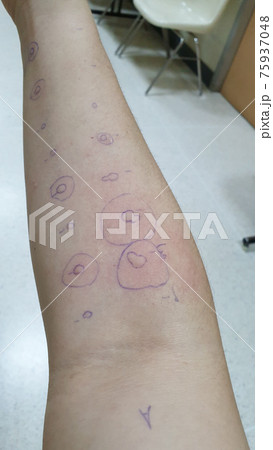 Arm test of allergy droplet examination sensitive symptom red rash all over 75937048