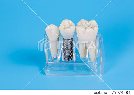 Dental crowns, imitation of a dental prosthesis of a dental bridge with implant Dental crowns, imitation of a dental prosthesis of a dental bridge with implant 75974201