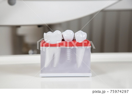 Plastic dental crowns, imitation of a dental prosthesis of a dental bridge 75974297