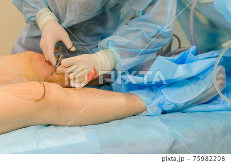 Surgeons suture their knees after liposuction. Close-up of plastic surgery to remove excess fat. 75982208