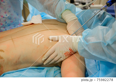 Plastic surgery to reduce body volume. The process of liposuction of the back of a woman. Pumping out subcutaneous fat in the operating room. 75982278