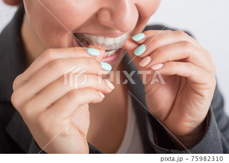 Close-up of a woman putting on transparent plastic retainers. The girl uses a device to straighten her teeth 75982310
