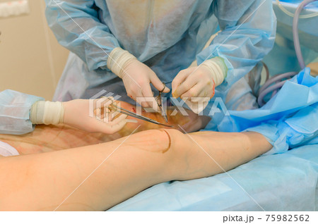 Surgeons suture their knees after liposuction. Close-up of plastic surgery to remove excess fat. 75982562