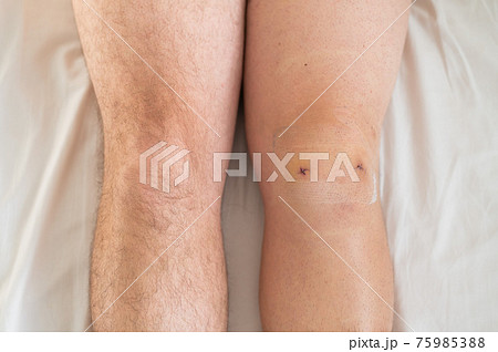 Close-up of a surgical suture after laparoscopic minisk surgery. A man with one knee operated on 75985388