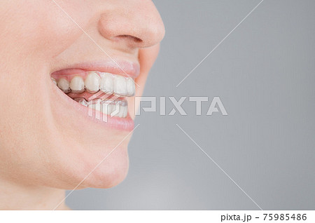 Close-up portrait of a woman with a plastic transparent retainer. A girl corrects a bite with the help of an orthodontic device. Copy space Close-up portrait of a woman with a plastic transparent retainer. A girl corrects a bite with the help of an orthodontic device. Copy space 75985486
