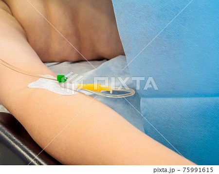 Intravenous drip during surgery in the patient's hand. Intravenous drip during surgery in the patient's hand. 75991615