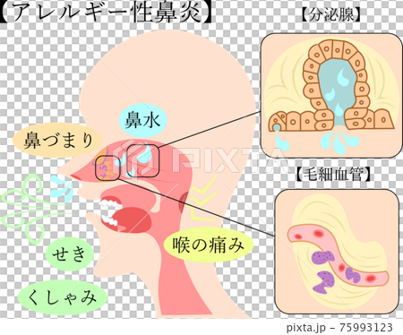 過敏性鼻炎插畫解說 75993123