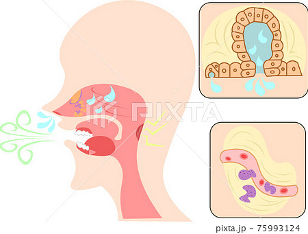 アレルギー性鼻炎　イラスト 75993124