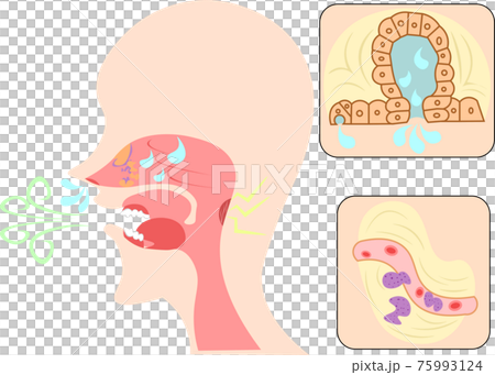 アレルギー性鼻炎　イラスト 75993124
