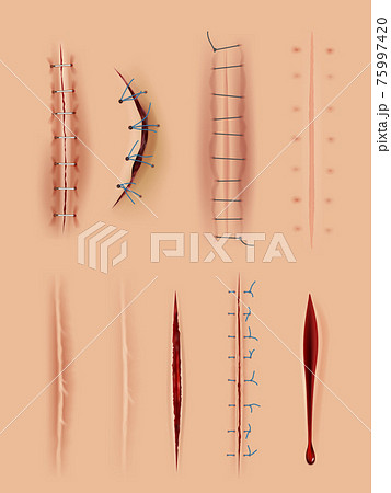 Realistic Scars Medical Surgical Sutures のイラスト素材