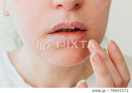 Close up of girl lips affected by herpes. Treatment of herpes infection and virus. Part of young woman face with finger touching pain on lips with herpes affected. Beauty dermatology concept. 76005371