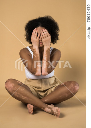 Woman with vitiligo disease skin hiding her face with her hands while posing 76012430