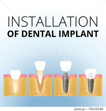 implantation of the tooth implantation of the tooth 76039386