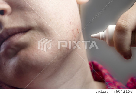 Acne on the chin: demodecosis tick on the skin of a girl's face. Patient at the appointment of a dermatologist. Problem skin and beauty concept. Acne on the chin: demodecosis tick on the skin of a girl's face. Patient at the appointment of a dermatologist. Problem skin and beauty concept. 76042156