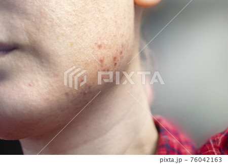 Acne on the chin: demodecosis tick on the skin of a girl's face. Patient at the appointment of a dermatologist. Problem skin and beauty concept. Acne on the chin: demodecosis tick on the skin of a girl's face. Patient at the appointment of a dermatologist. Problem skin and beauty concept. 76042163
