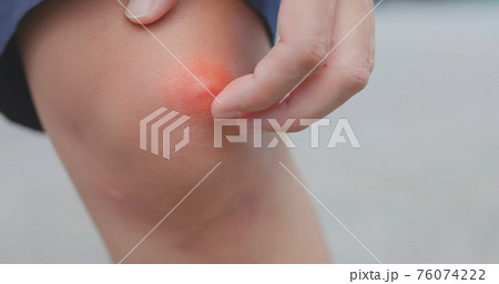 Man scratch itchy mosquito bump 76074222