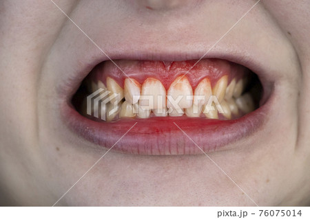 Gum bleeding and inflammation close up. A man examined by a dentist. The diagnosis of gingivitis 76075014