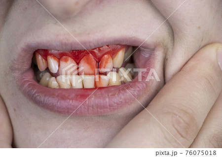 The man has blood on his teeth, severe bleeding of the gums after a blow to the jaw. Close-up of teeth after a fight or bruise 76075018