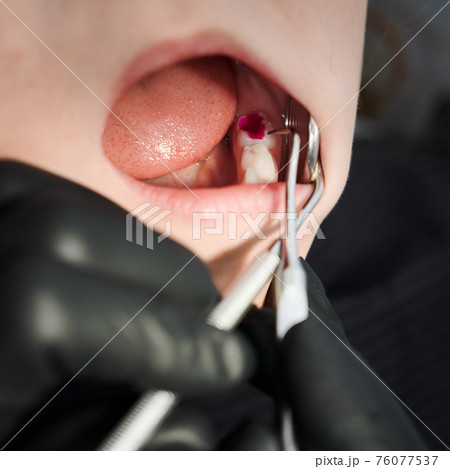 Stomatologist hands examining child teeth in dental office. 76077537