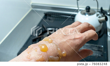 手の火傷 水ぶくれ 男がキッチンに立つと コロナ禍で火傷が増加の写真素材 手の火傷 水ぶくれ 男がキッチンに立つと コロナ禍で火傷が増加の写真素材
