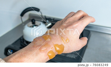 手の火傷 水ぶくれ 男がキッチンに立つと コロナ禍で火傷が増加の写真素材 手の火傷 水ぶくれ 男がキッチンに立つと コロナ禍で火傷が増加の写真素材