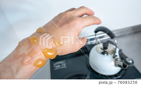 手の火傷　水ぶくれ　男がキッチンに立つと　コロナ禍で火傷が増加 76083256