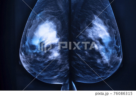 Breast mamogram xray test Breast mamogram xray test 76086315