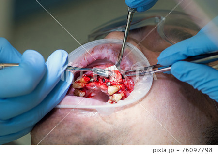 Surgery operation to install four dental implants on the upper jaw. Dental care and treatment. Teeth problems. 76097798