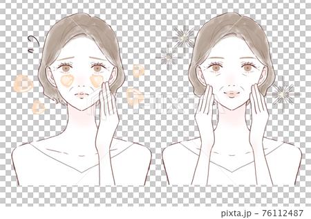 中年婦女患油性皮膚前後 中年婦女患油性皮膚前後 76112487