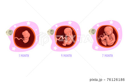 Stages of Embryo Development Set, 1, 4, 7 Month Cartoon Vector Illustration Stages of Embryo Development Set, 1, 4, 7 Month Cartoon Vector Illustration 76126186