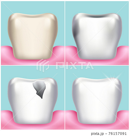 Dental problems, caries, plaque and gum disease, healthy tooth illustration 76157091
