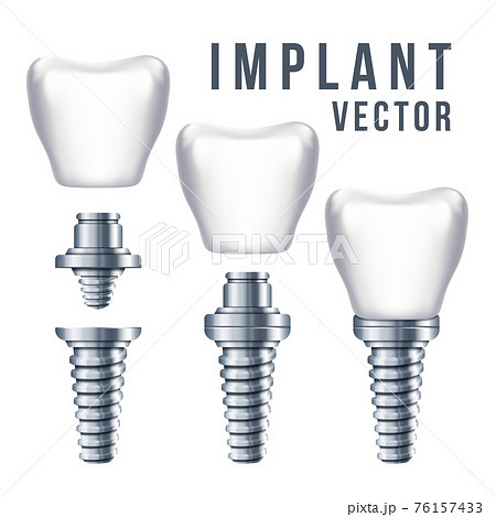 Dental tooth implant and parts illustration 76157433