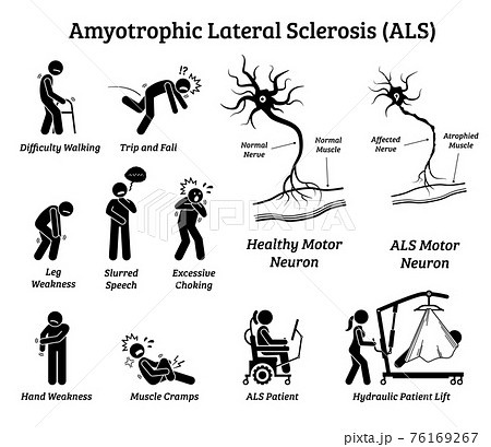 Amyotrophic lateral sclerosis ALS disease signs and symptoms. Illustrations depict nervous system or neurological disease in ALS patient. Amyotrophic lateral sclerosis ALS disease signs and symptoms. Illustrations depict nervous system or neurological disease in ALS patient. 76169267