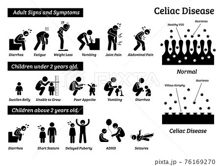 Celiac disease signs and symptoms. Illustrations depict celiac disease problems in adult and children. Celiac disease signs and symptoms. Illustrations depict celiac disease problems in adult and children. 76169270