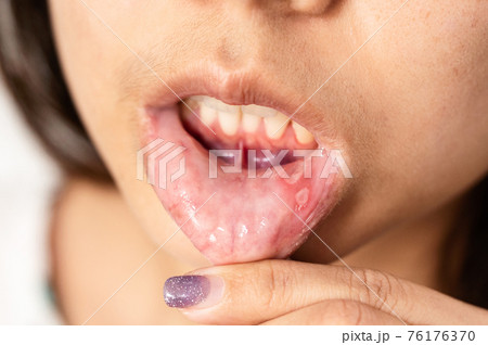 Asian woman have Aphthous ulcer or Canker sore on mouth at lip Asian woman have Aphthous ulcer or Canker sore on mouth at lip 76176370