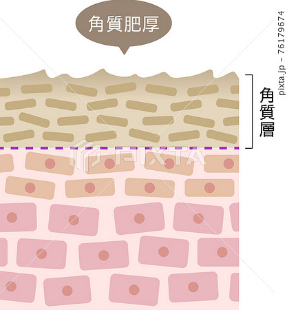 角質肥厚　断面図 76179674