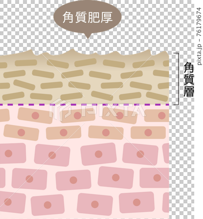 角質肥厚　断面図 76179674