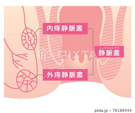 肛門の構造のイラスト 76189544