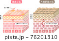 角質肥厚　健康な肌　断面図　立体 76201310