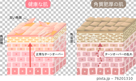 角質肥厚 健康な肌 断面図 立体 角質肥厚 健康な肌 断面図 立体 76201310