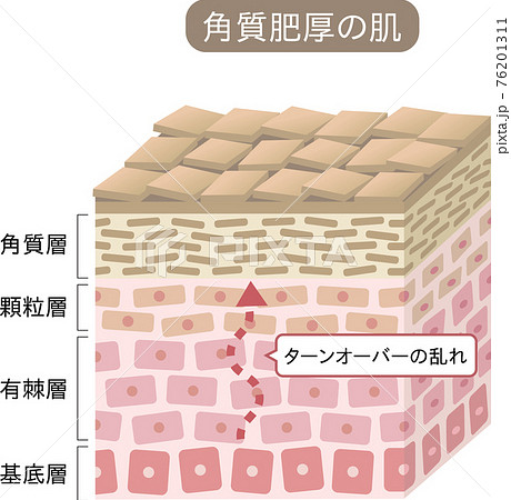 角質肥厚 断面図 立体 角質肥厚 断面図 立体 76201311