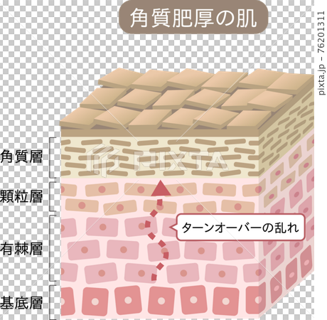 角化過度橫斷面三維 76201311