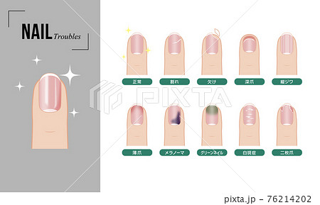 ネイルのトラブルセット（カラー） 76214202