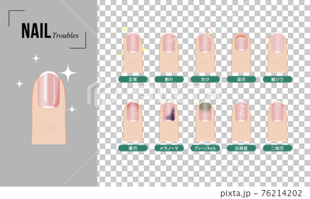 ネイルのトラブルセット（カラー） 76214202